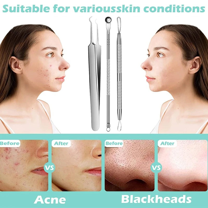Blackhead and Acne Removal Needles Kit