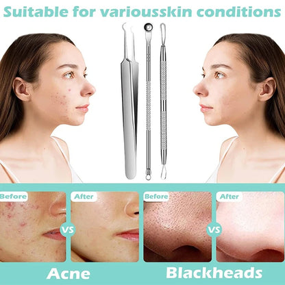 Blackhead and Acne Removal Needles Kit