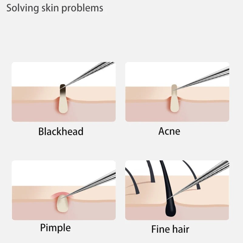 Blackhead and Acne Removal Needles Kit